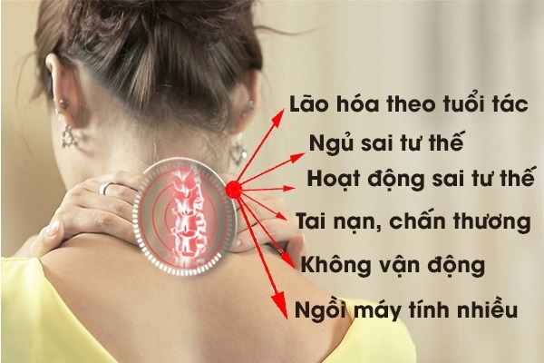 Các nguyên nhân gây thoái hoá đốt sống cổ