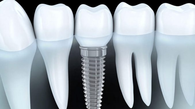 Implant nha khoa chỉnh răng