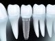 Implant nha khoa chỉnh răng
