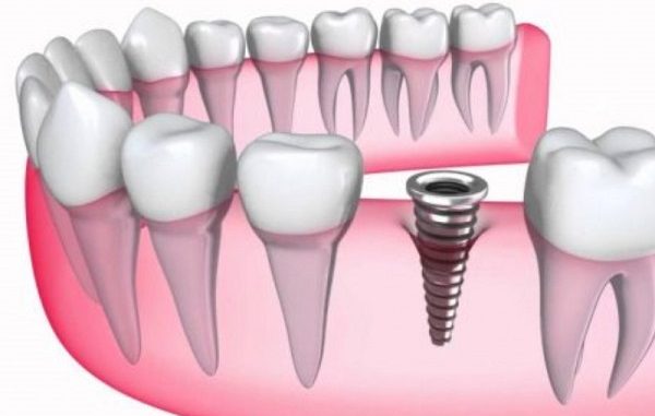 Implant nha khoa