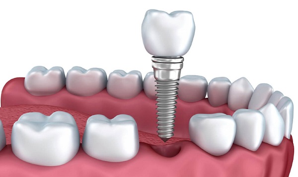 Trường hợp implant nha khoa