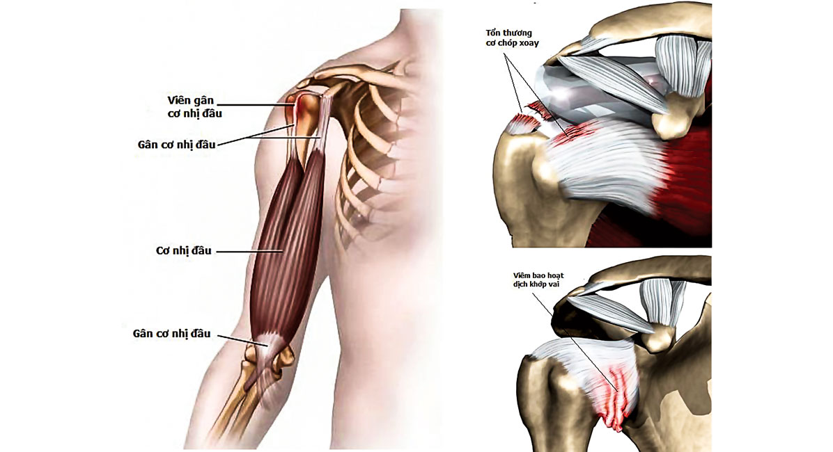 Qúa trình điều trị rách chóp xoay tại vai