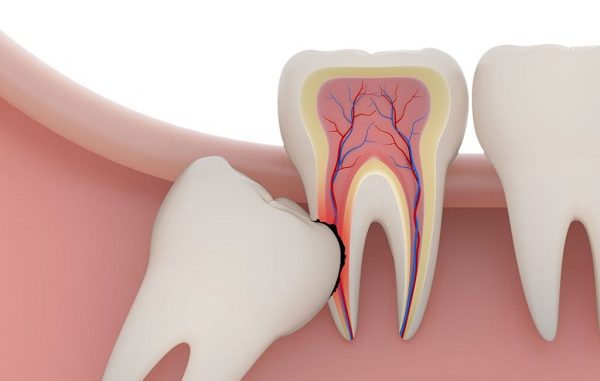 Bạn đã biết răng khôn là gì?