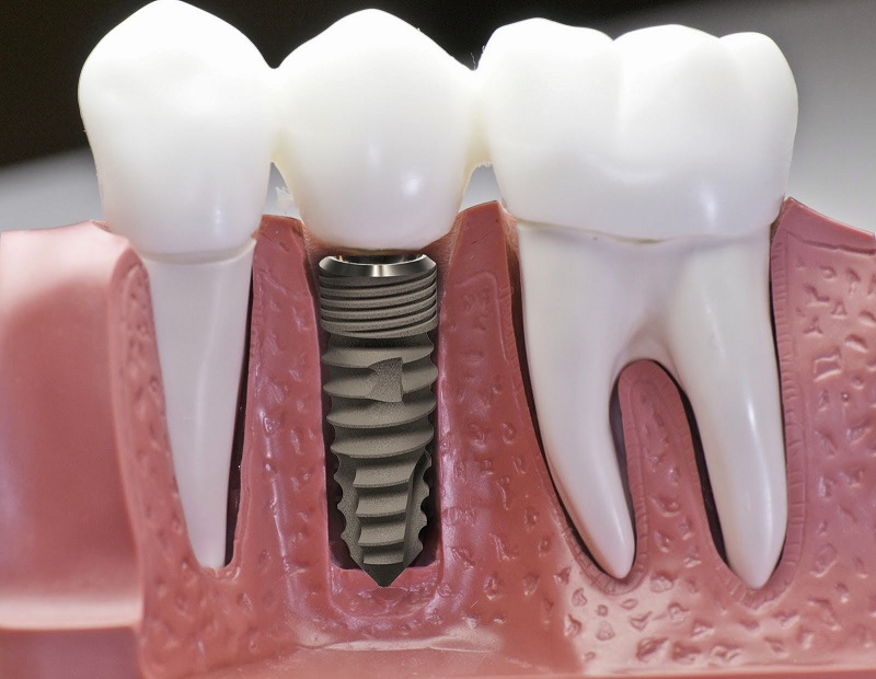 Trồng răng implant là gì? Những điều cần biết