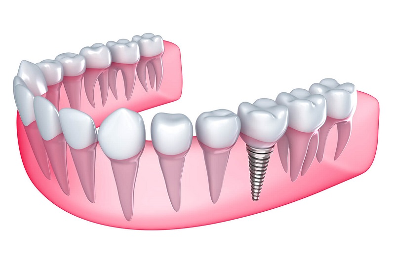 Trường hợp nên cấy ghép implant