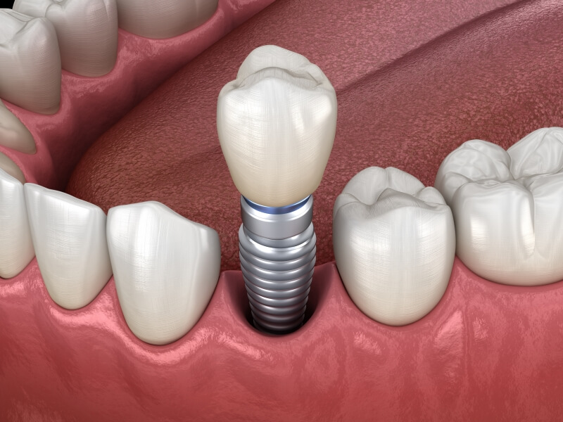 Quy trình trồng răng implant trong nha khoa