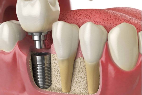 Cấy ghép Implant tiêu chuẩn