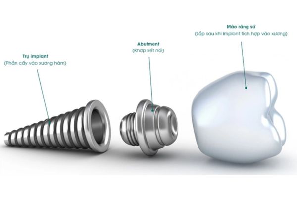 Trụ Implant là gì?