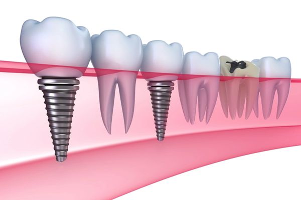 Cấy ghép Implant