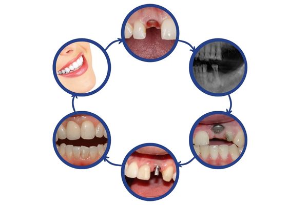 Quy trình cấy ghép Implant