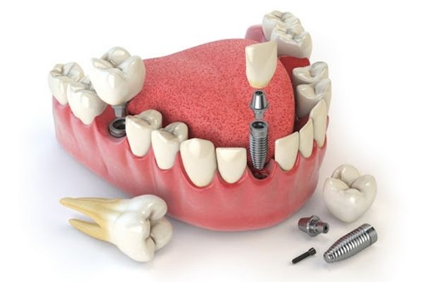 Lưu ý khi cấy ghép Implant