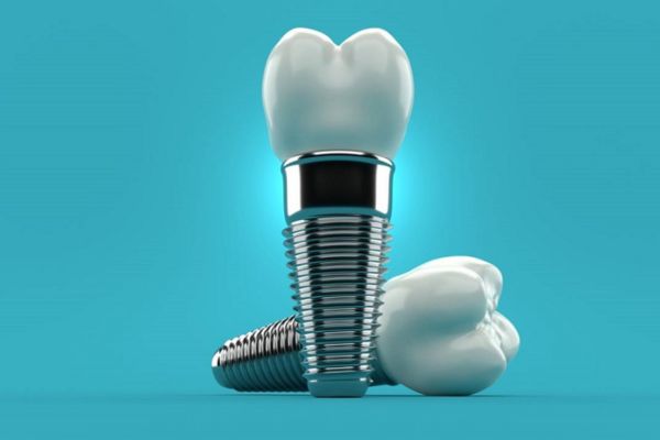 Tiêu chí chọn trụ Implant