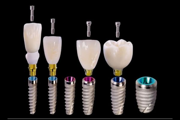 Top 4 trụ Implant