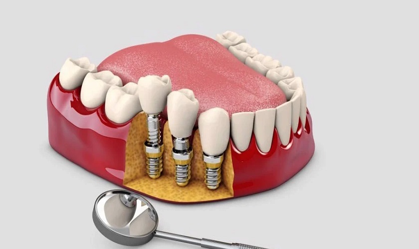 Mất răng lâu năm có trồng implant được không