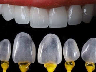 Các loại răng sứ phổ biến