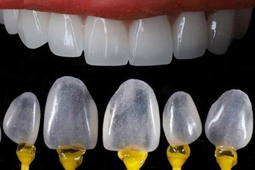 Các loại răng sứ phổ biến